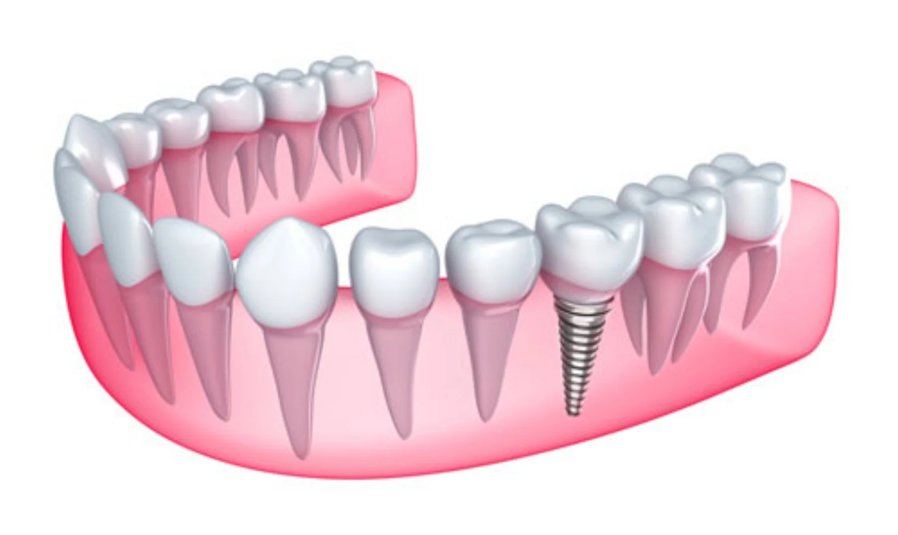 dental-crowns-ahwatukee-az.jpg