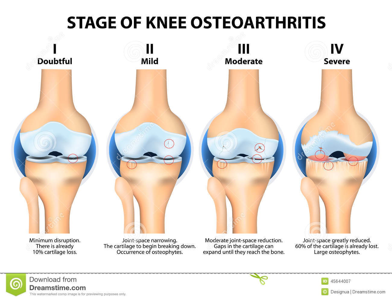 Exercise versus no exercise for the occurrence, severity and