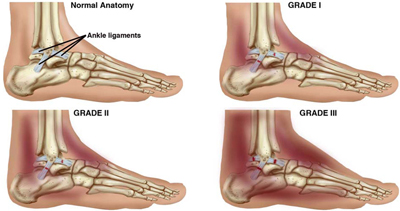 Ankle Sprain Causes, Sprained Ankle