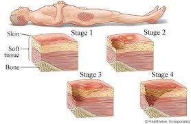 Pressure sores prone areas affected by body position on bed. (a).