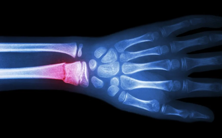 PT GUIDE TO WRIST FRACTURE — Champion Performance & Physical Therapy