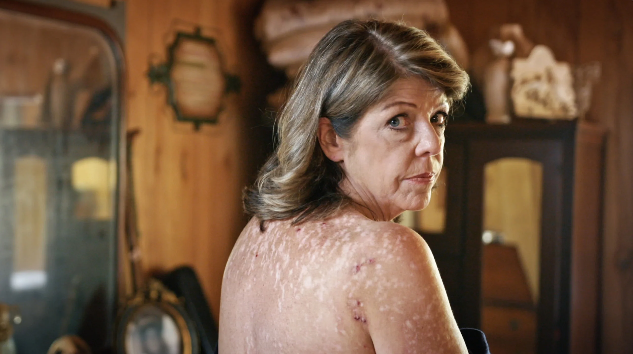Registered nurse Cindy Casey-Holman reveals her scars from Morgellons Disease.