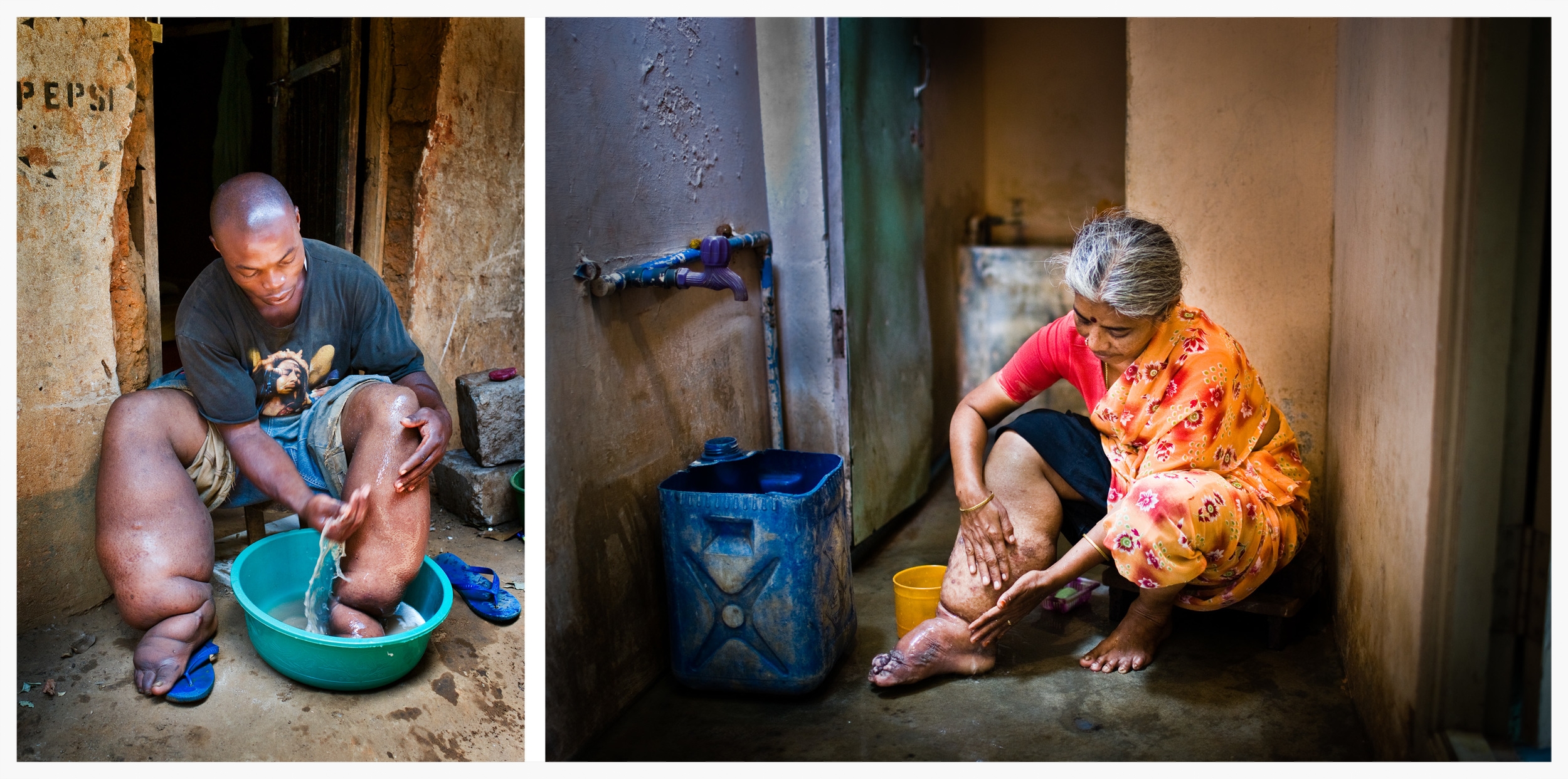 Lymphatic Filariasis. Photo: Marcus Perkins for GSK