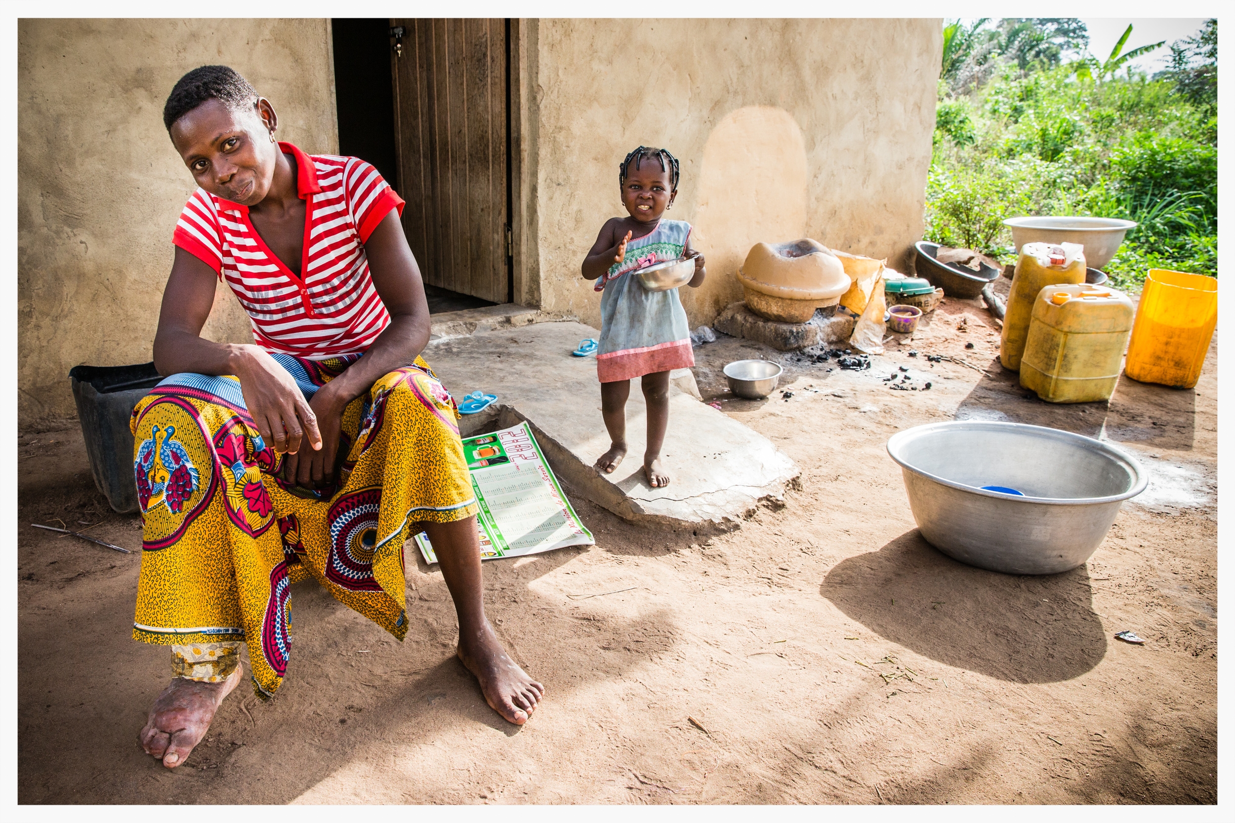 Lymphatic filariasis in Togo. Photo: Marcus Perkins for GSK