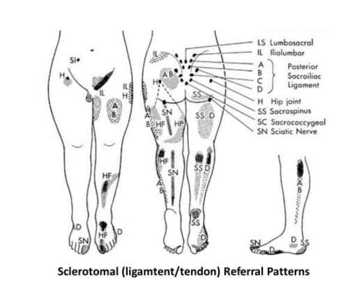 Sclerotomal (ligament/tendon) Referral Patterns