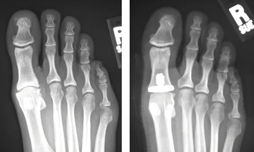 X-Ray Hallux Rigidus Vilex Hemi Implant.jpg