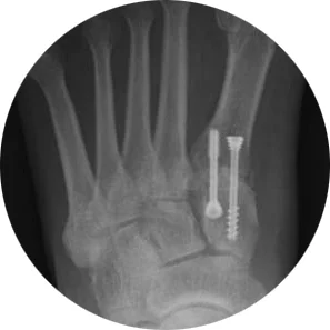 X-Ray-Lapidus Arthrodesis Vilex Headless Screw.jpg