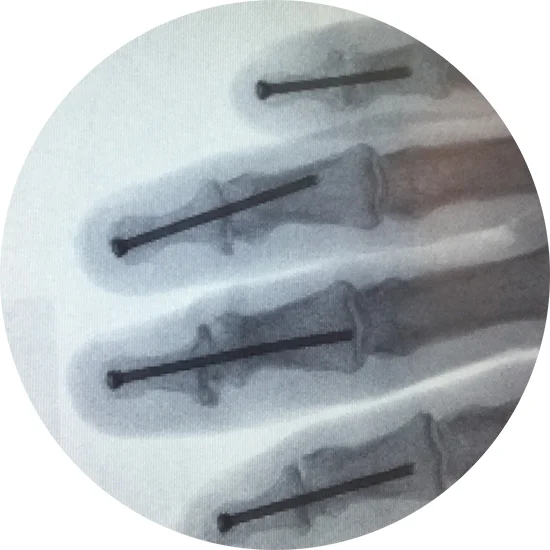 X-Ray_Hand DIP-Fusion-Surgery.jpg