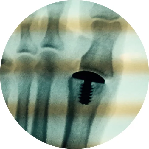 Dorsal X-ray Met head 1st.jpg