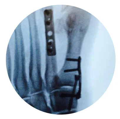 Lehigh Plate Case_20150312.jpg