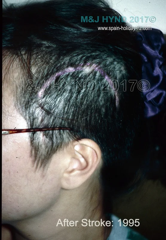 www-spain-holiday-nz-dot-com-after-stroke-CXH-surgery-scar-post-stroke05-edit.jpg