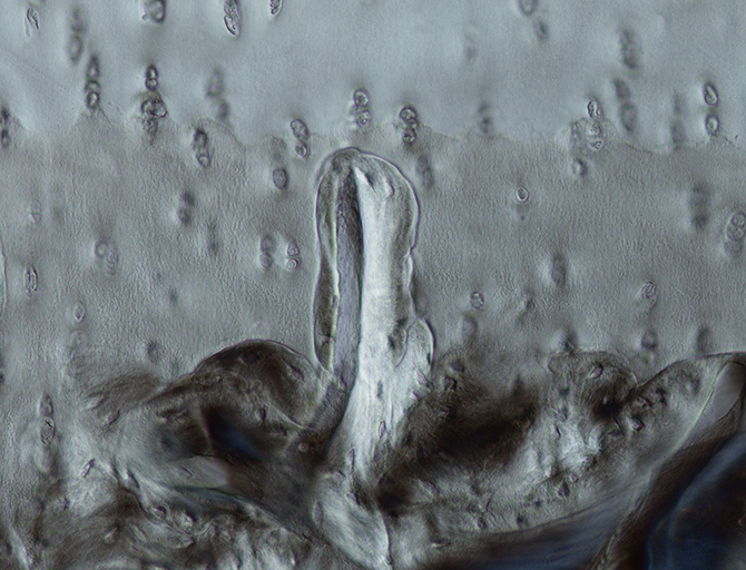 Osteoarthritis is a sinister disease! Because cartilage doesn’t contain any nerves, you usually only begin to experience joint pain once your cartilage has become significantly degenerated. We don’t have a good understanding of how the disease develops or what causes it in most cases. This image shows a bone spicule that has grown from the underlying bone into the cartilage. This bone invasion begins early in the disease, before the cartilage has be lost and may help us to understand how the disease progresses.