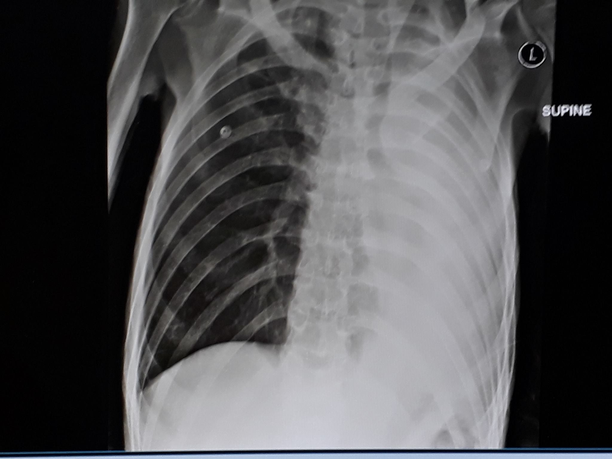 A different chest xray of severe lung damage after repeated bouts of Tuberculosis. The struggle is real.&nbsp;