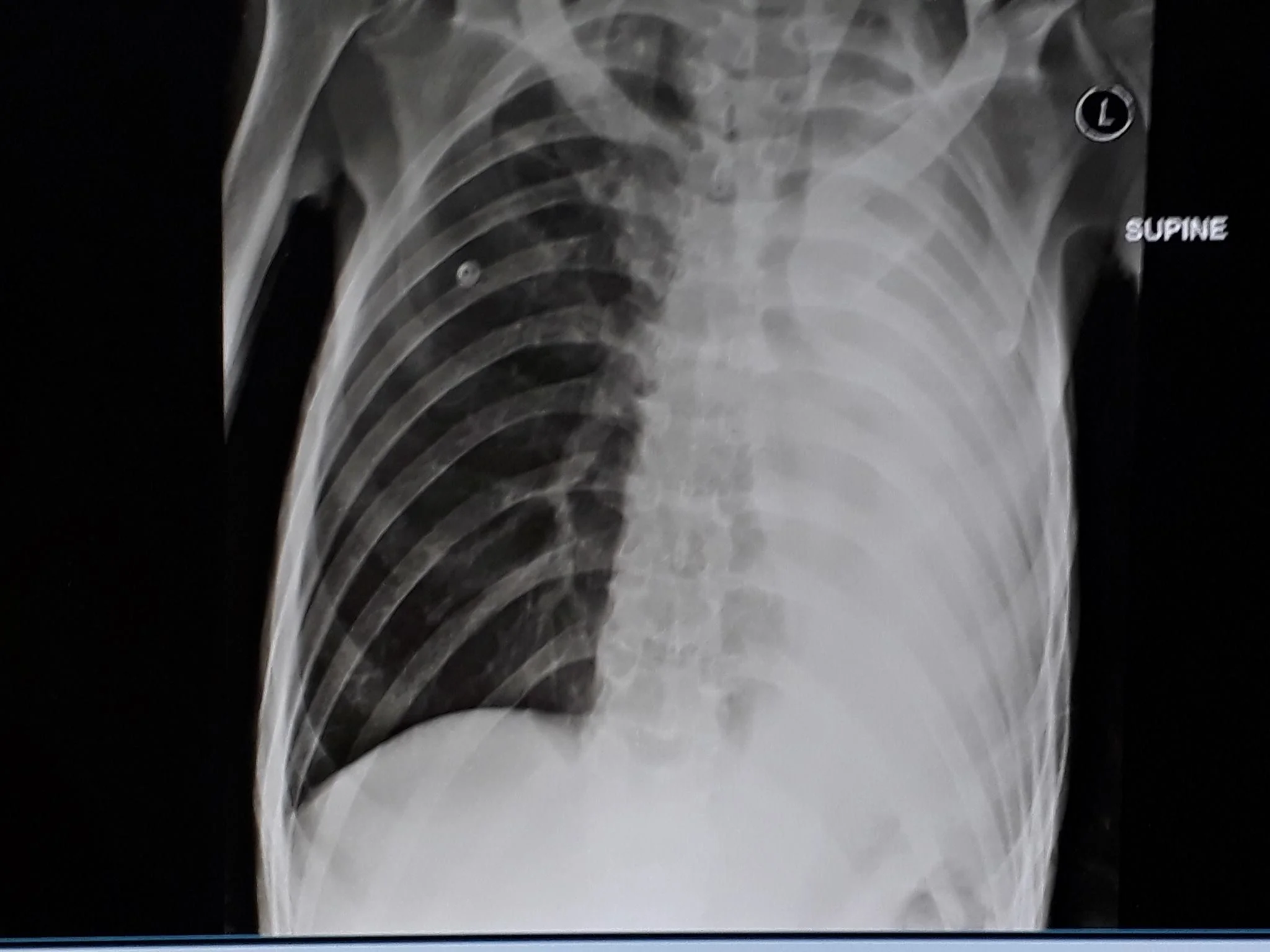 A different chest xray of severe lung damage after repeated bouts of Tuberculosis. The struggle is real. 