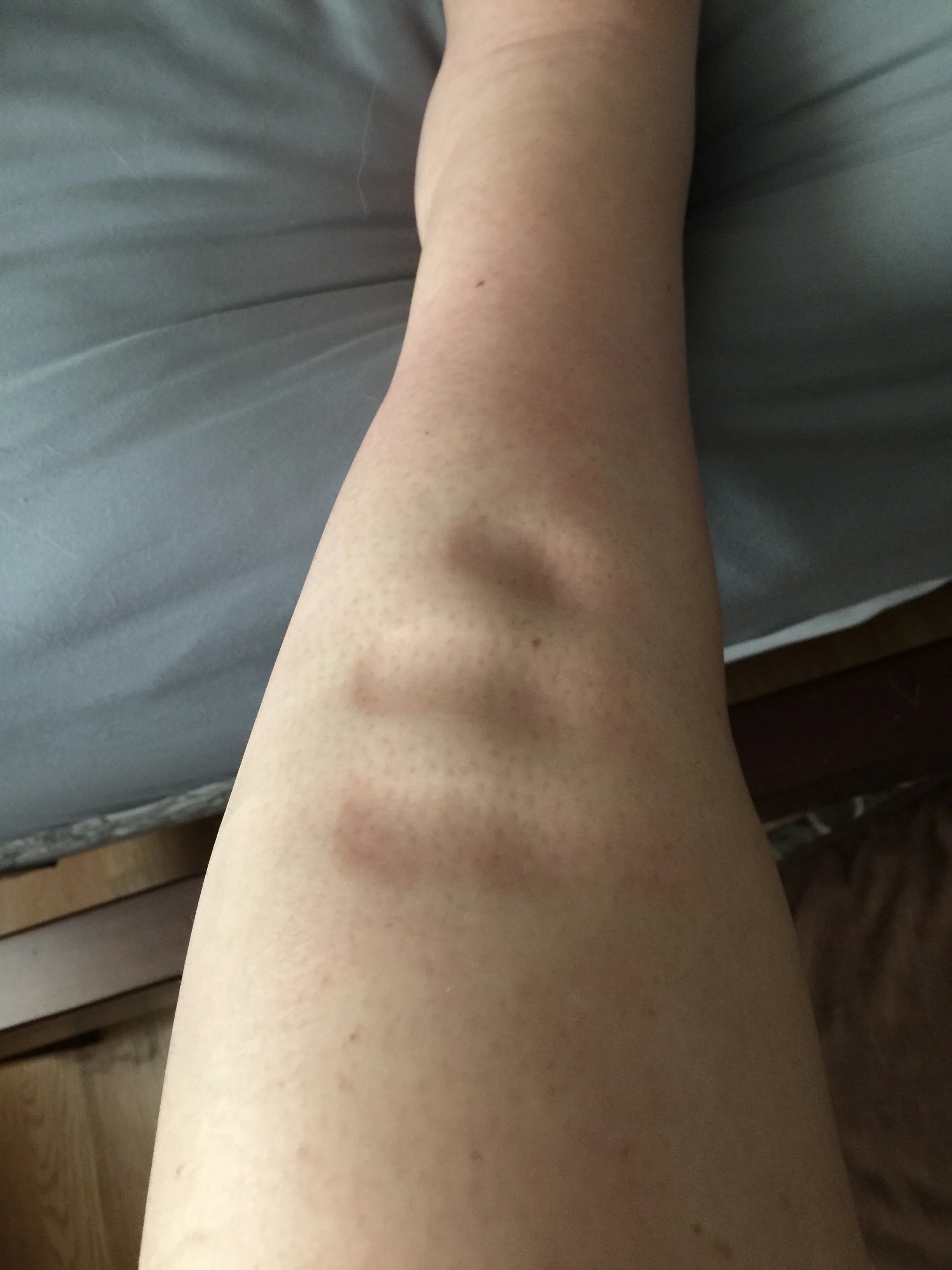 Shiny, squishy, impressionable edema skin!