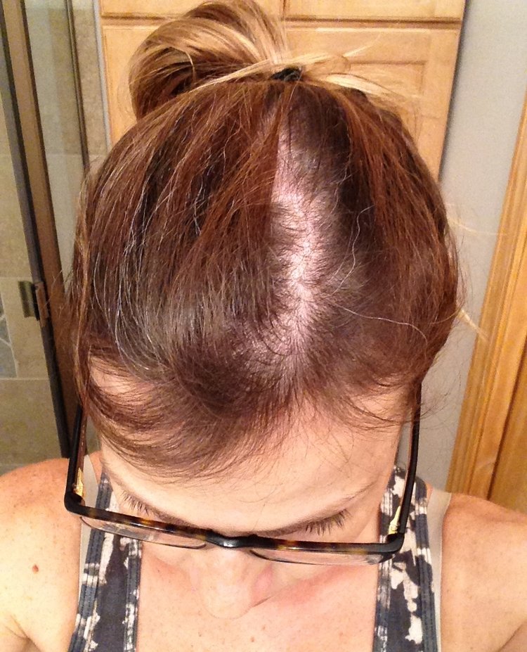 Solutions for Postpartum Hair Loss After Pregnancy — First Thyme Mom