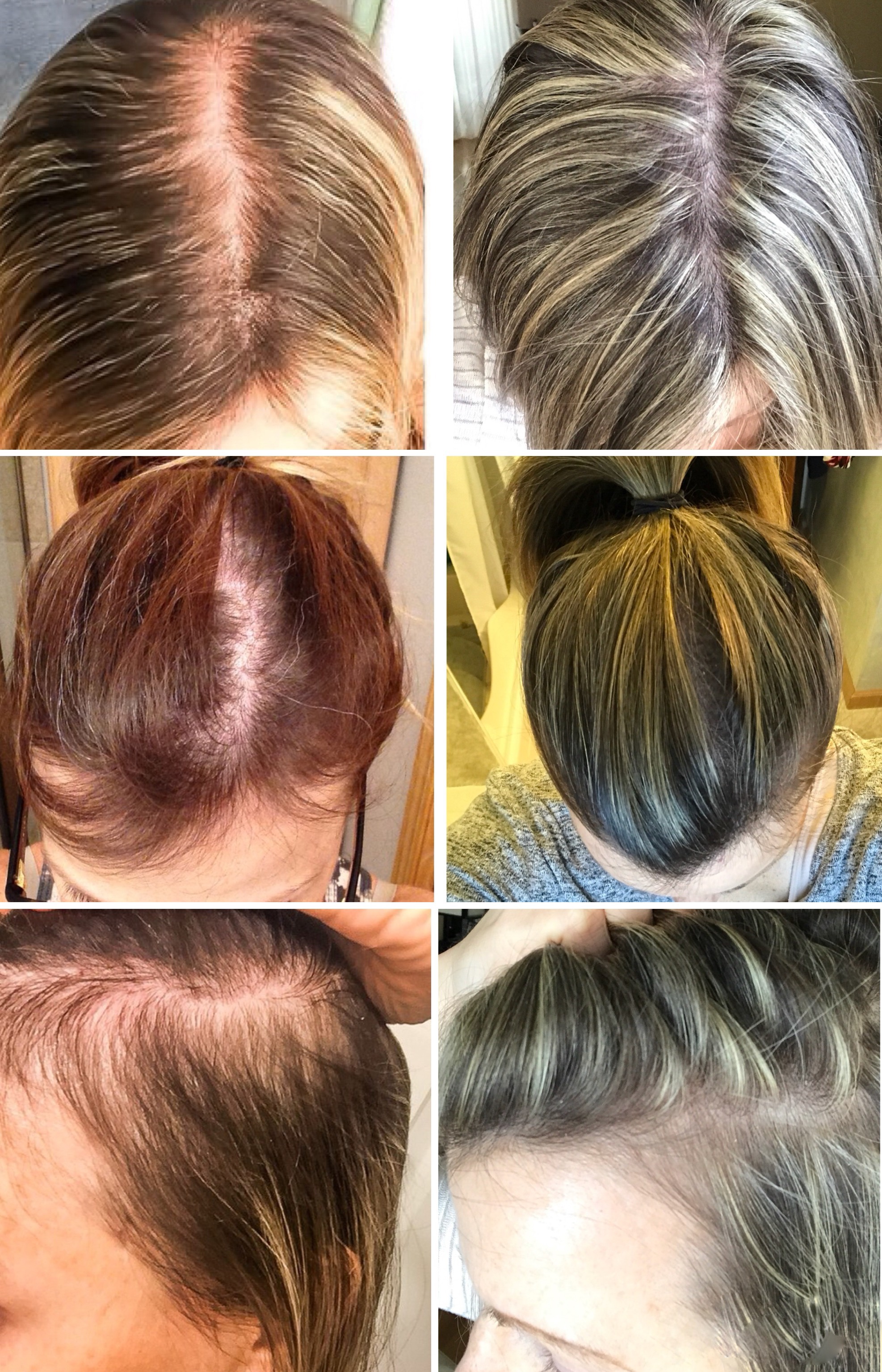 Women And Hair Loss: Causes, Solutions, and Support — First Thyme Mom