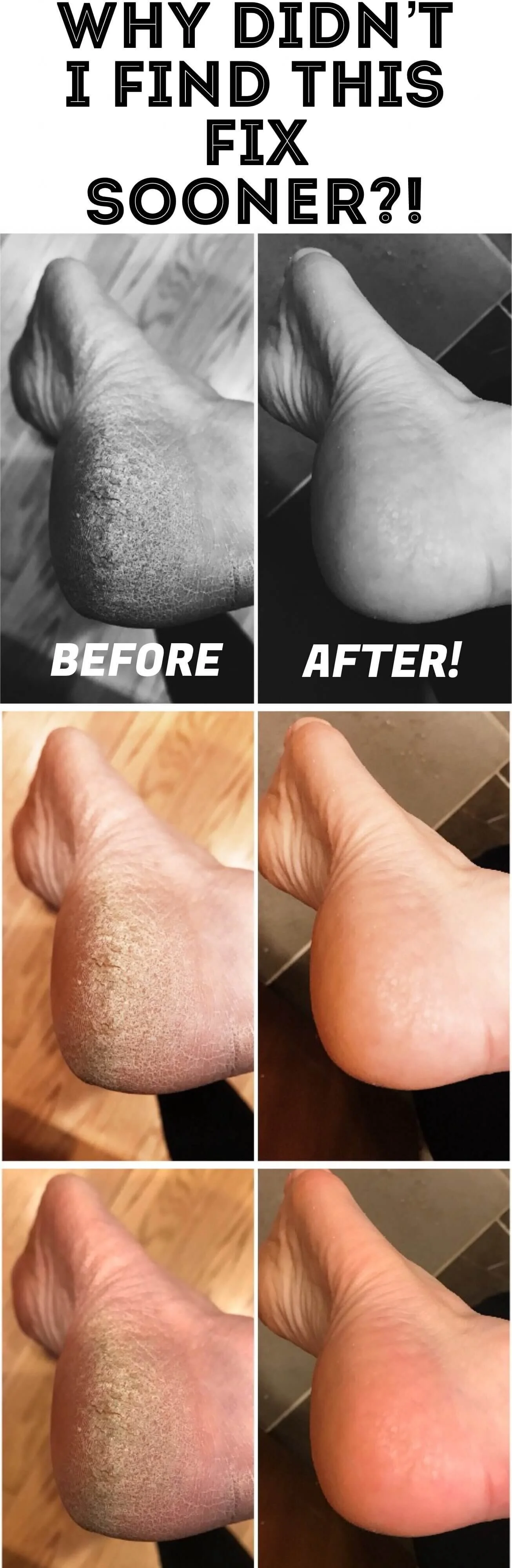 Toe Best Way To Get Rid Of Dry Cracked Heels Top Best Way To Cure Dry