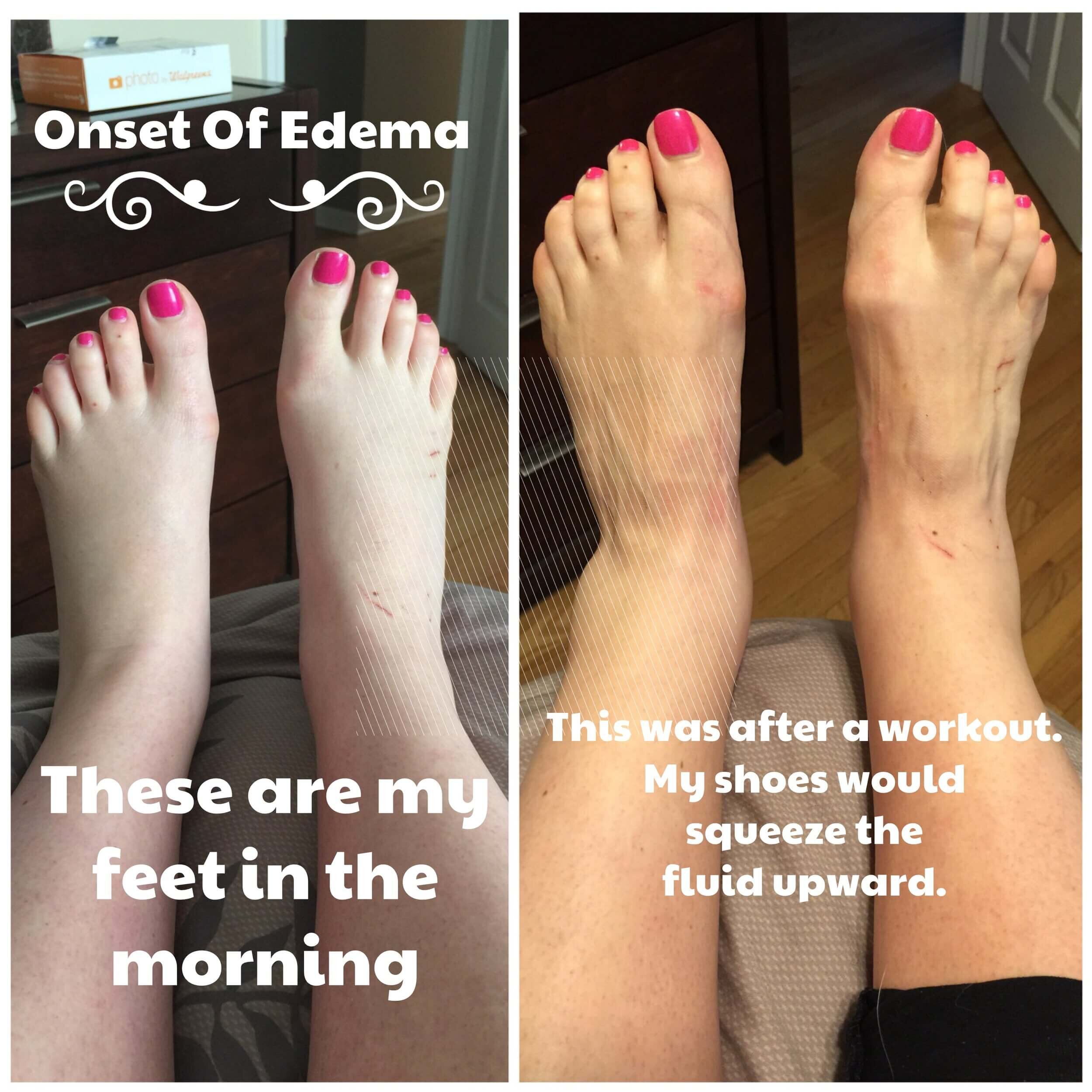 Swollen feet during pregnancy? Check these tips - Sanford Health News