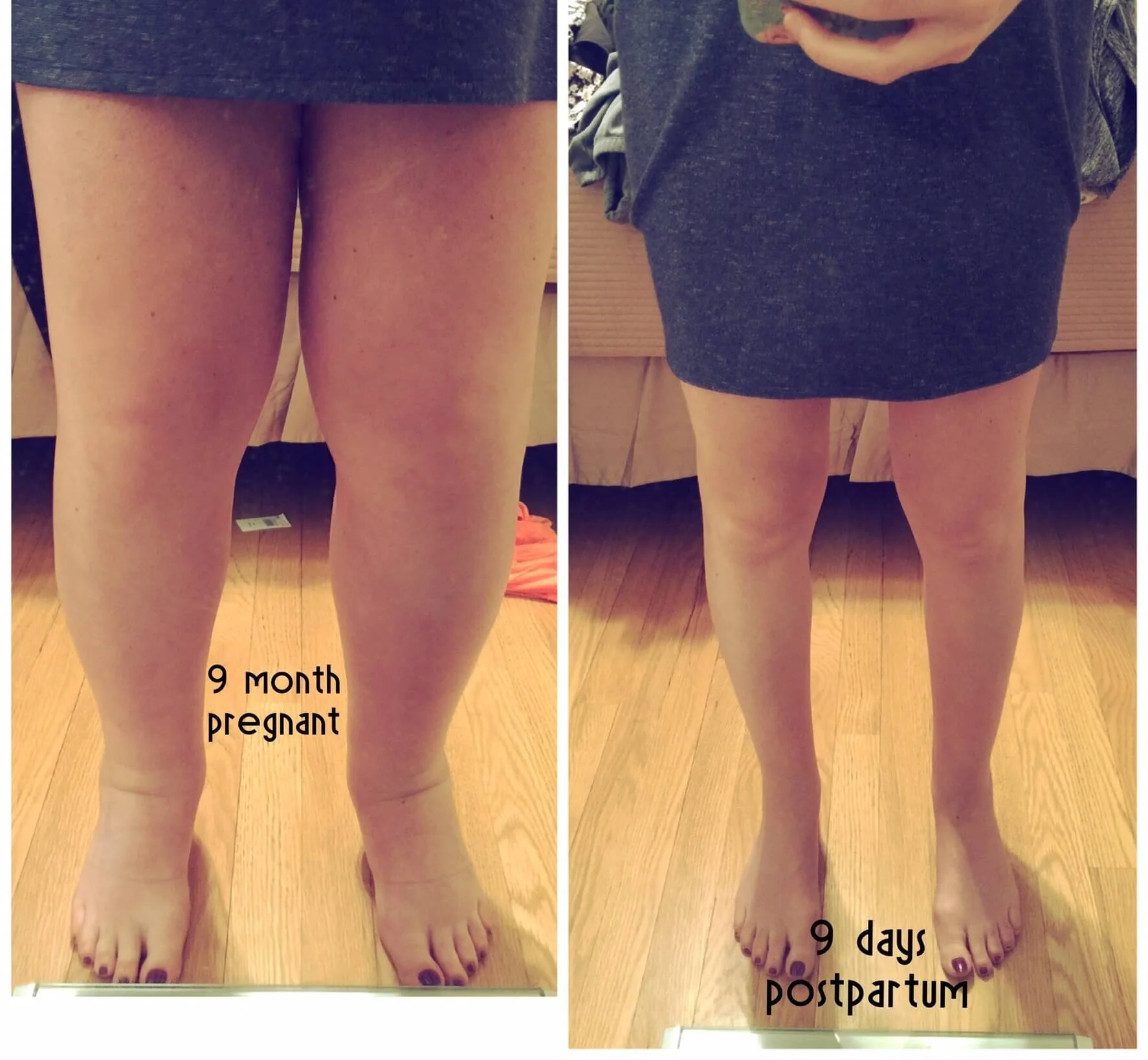 Отекшие ноги при беременности. Ноги при беременности форум. Ноги при беременности форум. Отек правой ноги при беременности. Отёк ног при беременности.