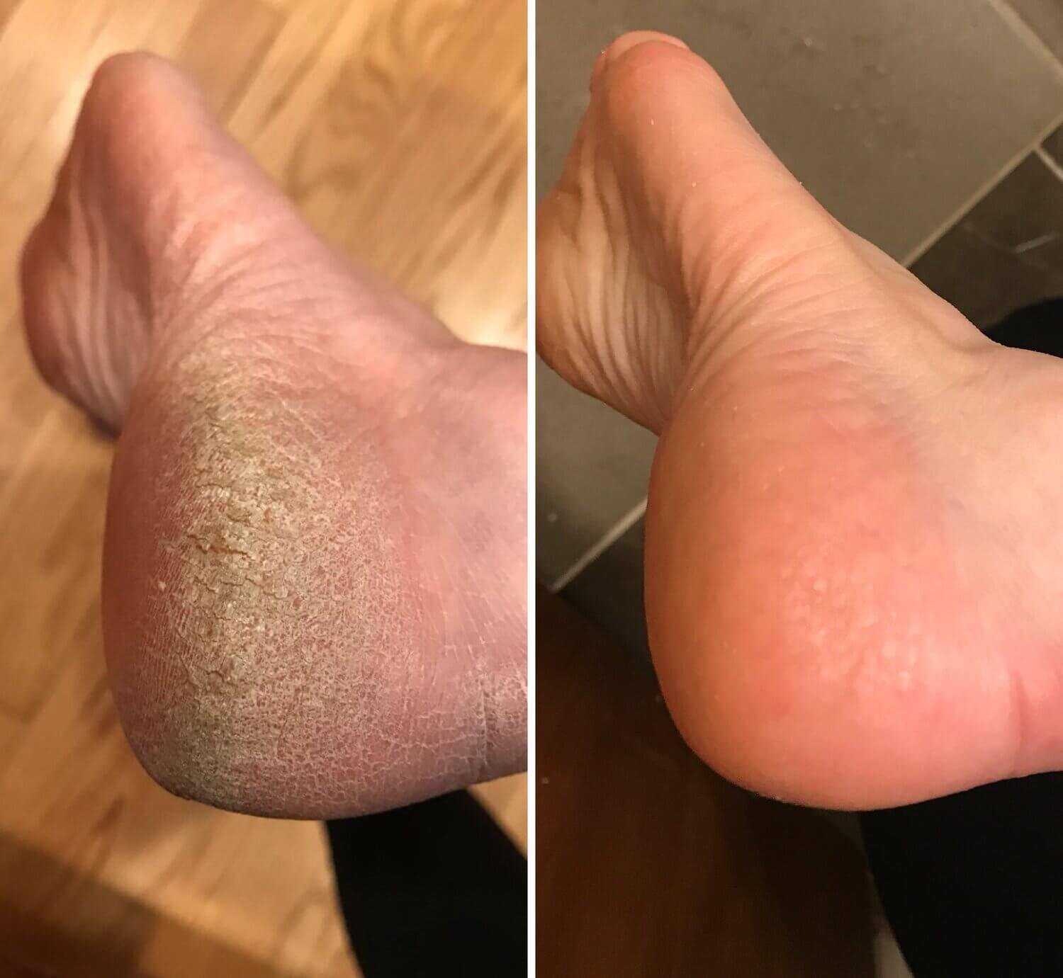Best Fix For Calluses - How I Fixed My Dry Feet — First Thyme Mom