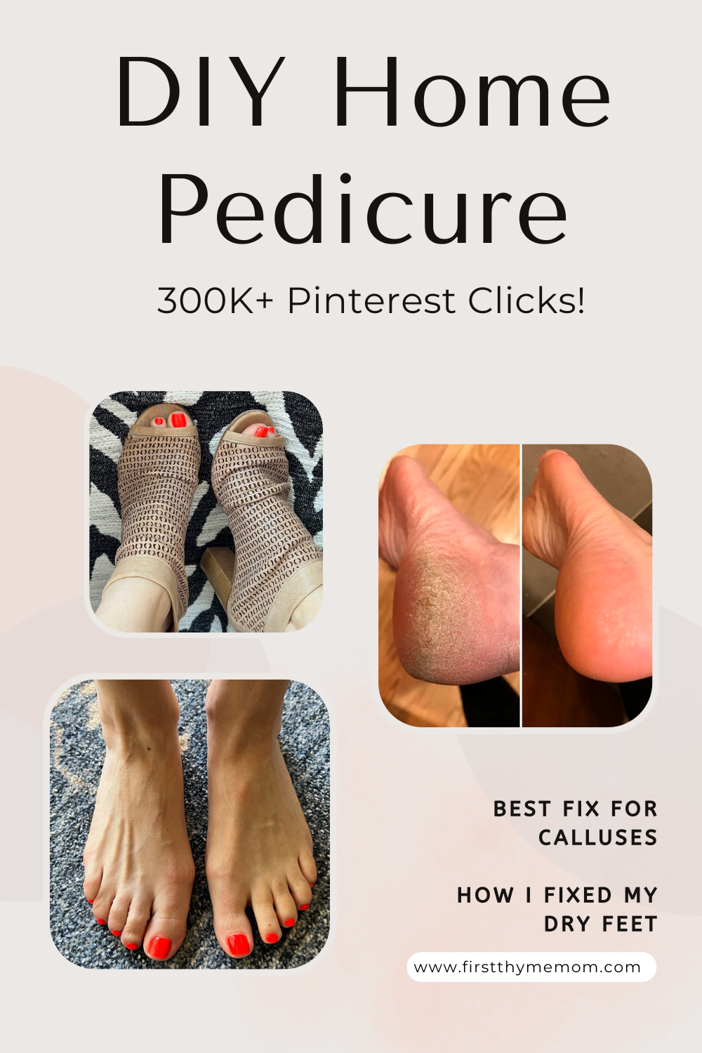 Toe Sore Cracked Heels Remedy Best Way To Treat Dry Cracked Heels