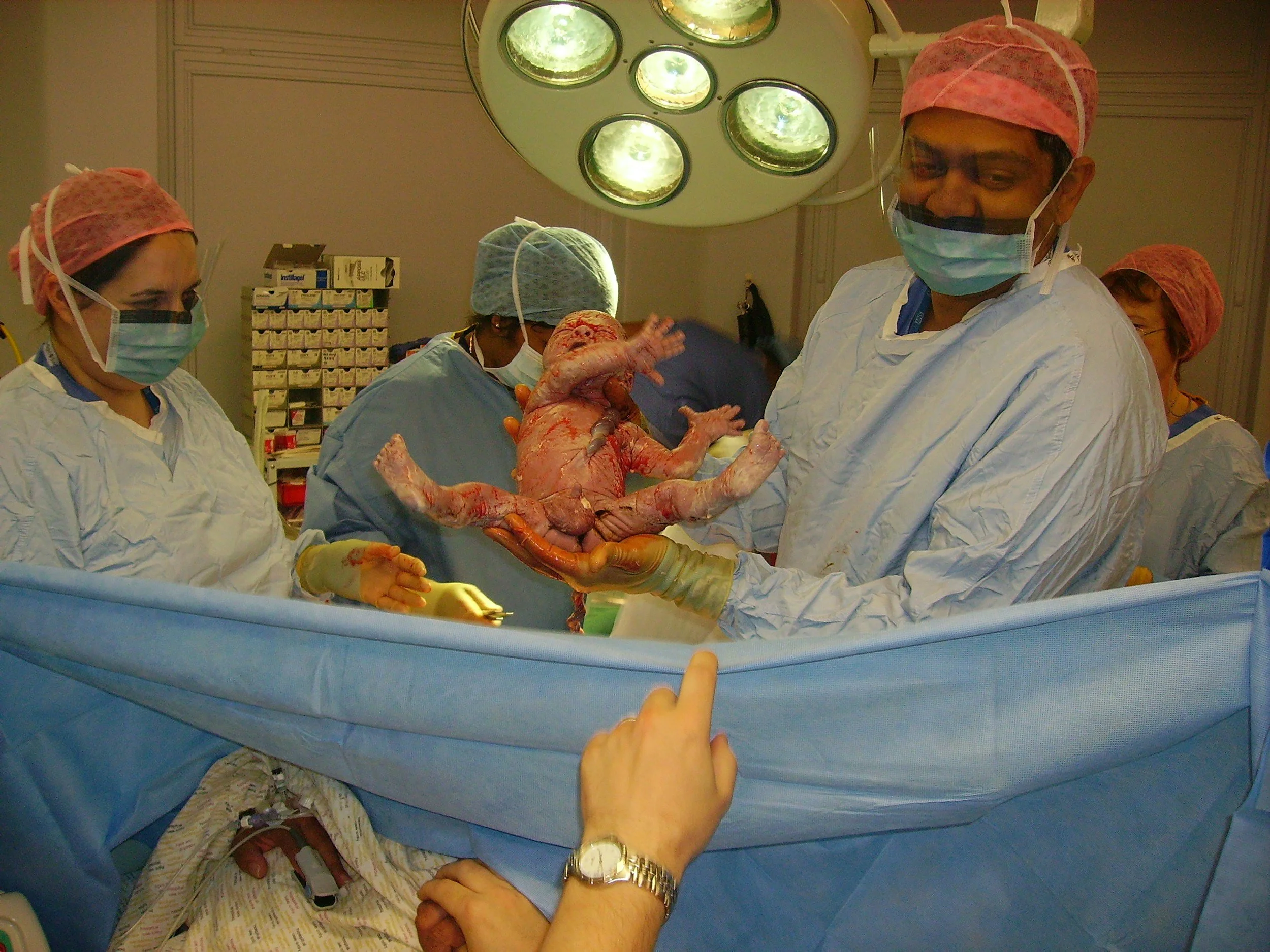 Breastfeeding After a C-Section: What the Evidence is telling us