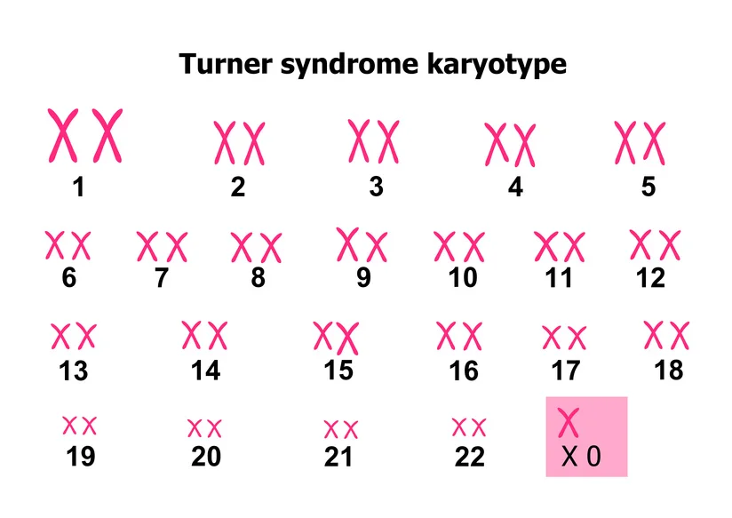 TurnerSyndrom — FertiPROTEKT