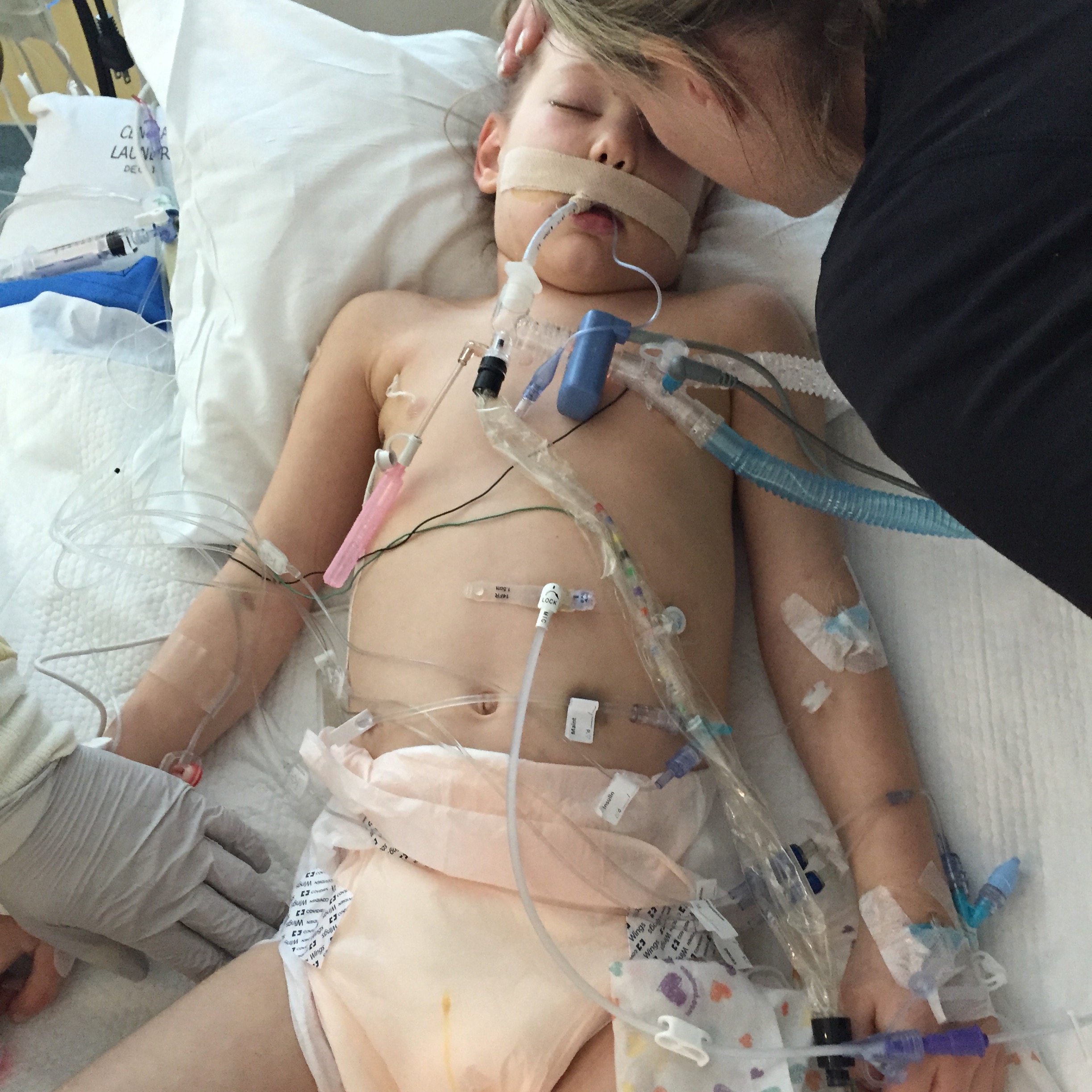 So many tubes. Kycie has a large bruise from her CGM (continuous glucose monitor) located just below her g-tube port. A pic-line was put into her right wrist. Kycie's neck and face are still puffy from the pneumothorax. 