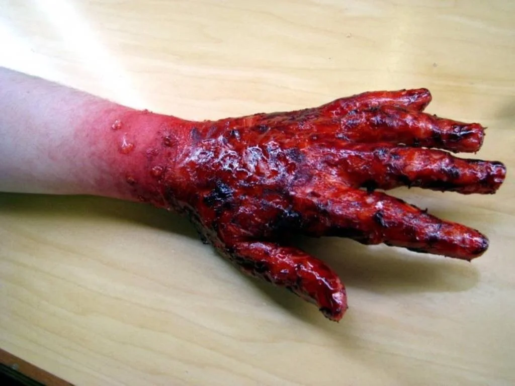 burnedhand.jpeg