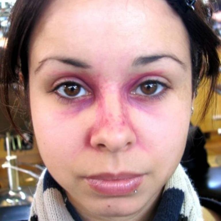 broken+nose+bruised.jpg