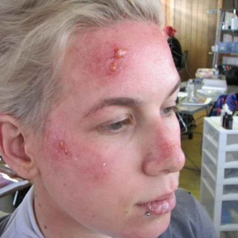 sunburn+3.jpg