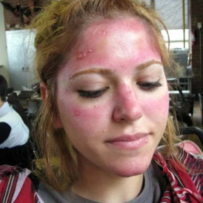 sunburn+1.jpg