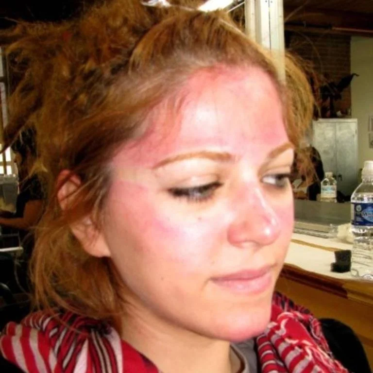 sunburn
