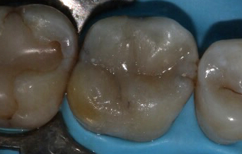 white fillings sydney. sydney cosmetic dentist.