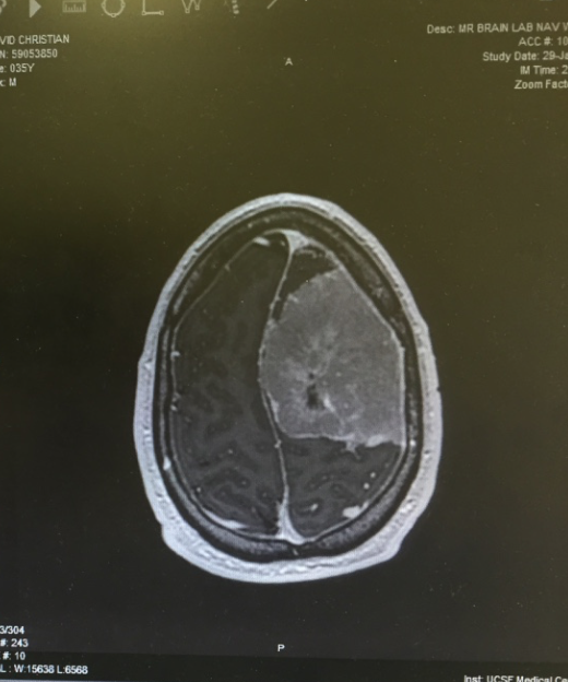 MRI view of Tumor from below