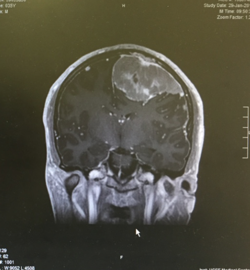 MRI view of tumor from behind
