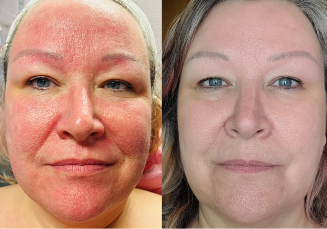 Side-by-side comparison of a woman's face showing severe redness and irritation on the left, and clear, even-toned skin on the right.