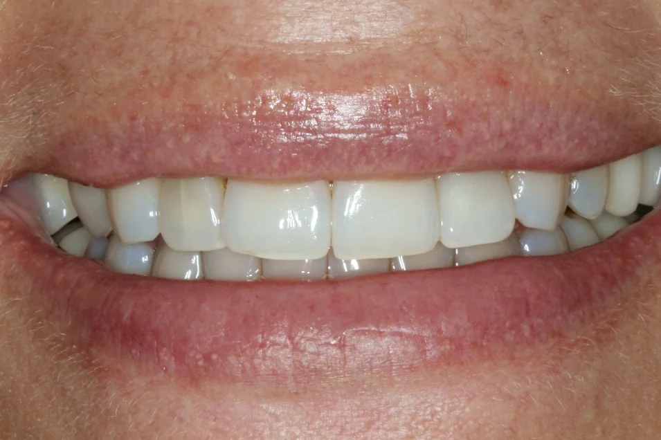 int-bleaching-1-1-1.jpg