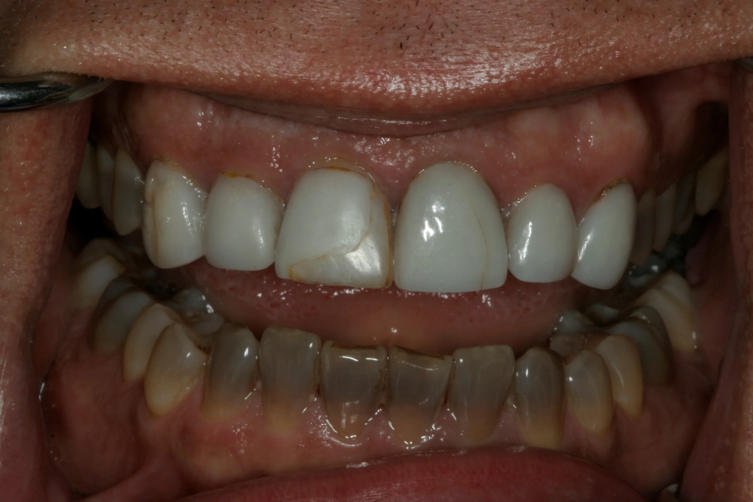 Clint's teeth before restorative work.