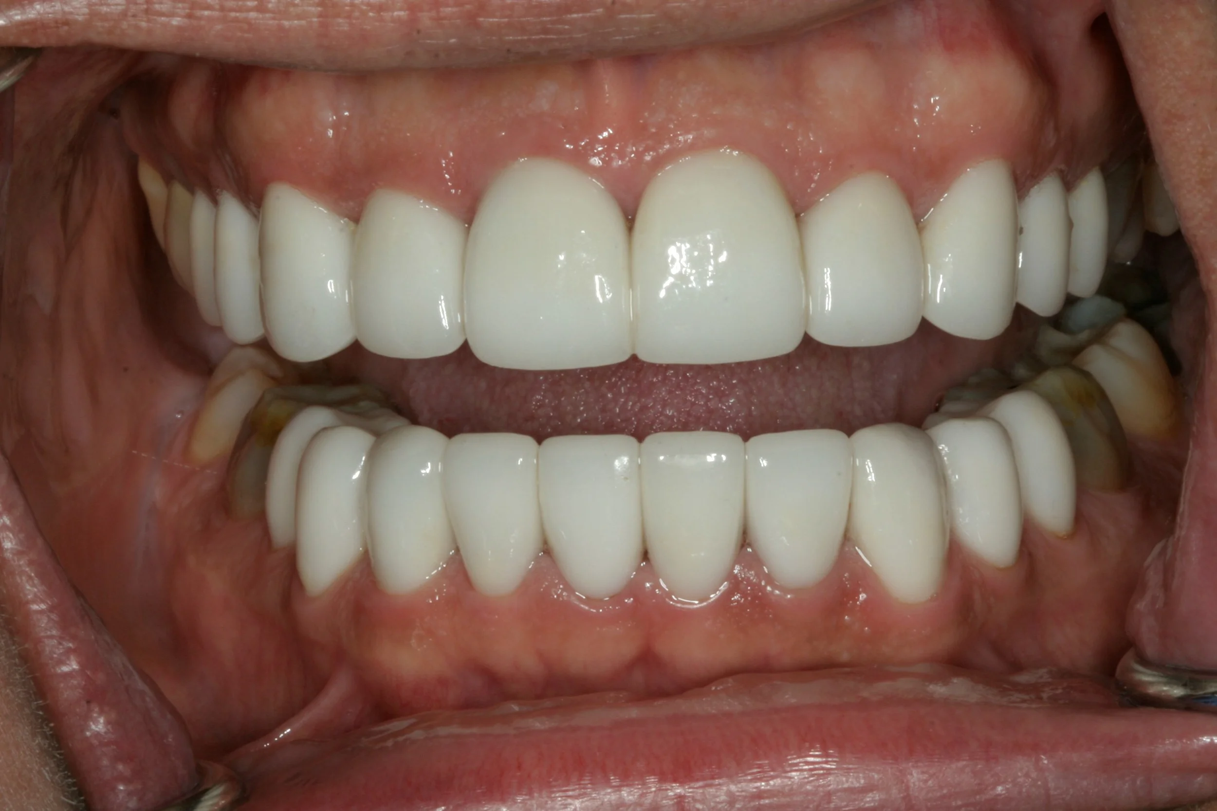 Clint's teeth after porcelain restoration.