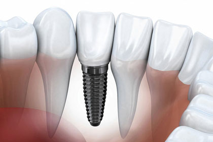 Pose implant + couronne céramique : à partir de CHF 2500- (frais labo inclus)