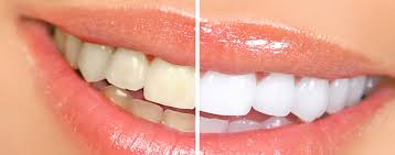 In-Office bleaching with lamp : CHF 600
