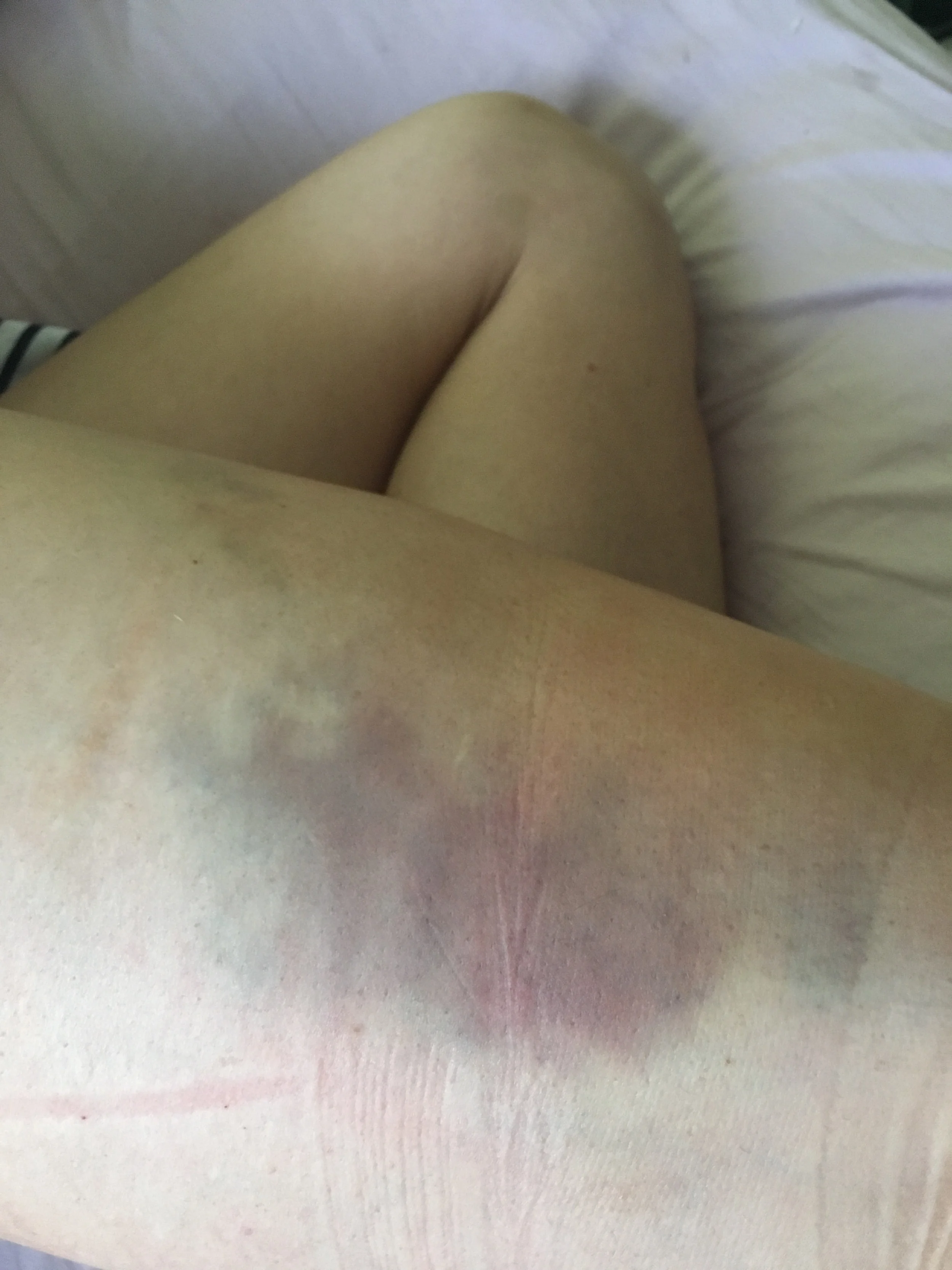 What my leg looked like 2-3 weeks post surgery