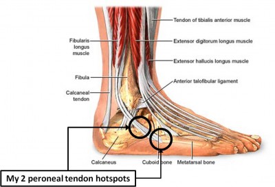 I didn't make this picture, but it perfectly sums up my foot issues!