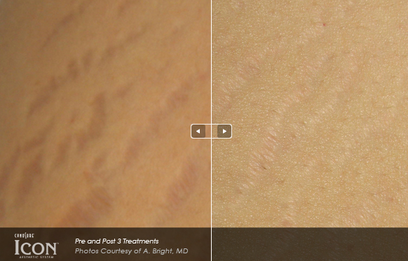 laser stretch mark treatment Icon.png