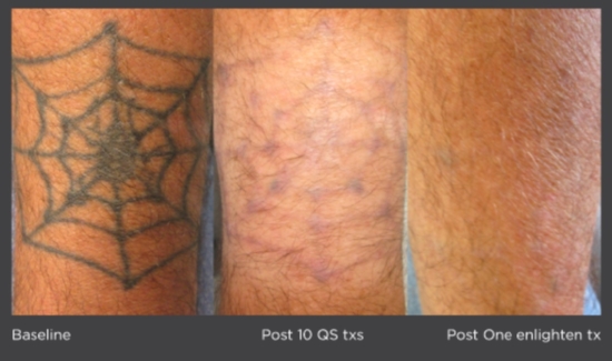 Tattoo Removal in action with the Cutera Enlighten - YouTube