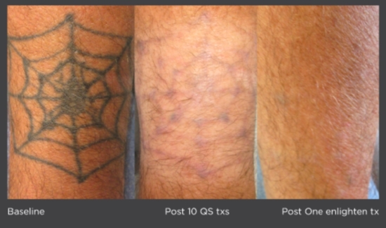 *individual results may vary Photo courtesy of Omar Ibrahimi, M.D., PhD Connecticut Skin Institute Stamford, CT