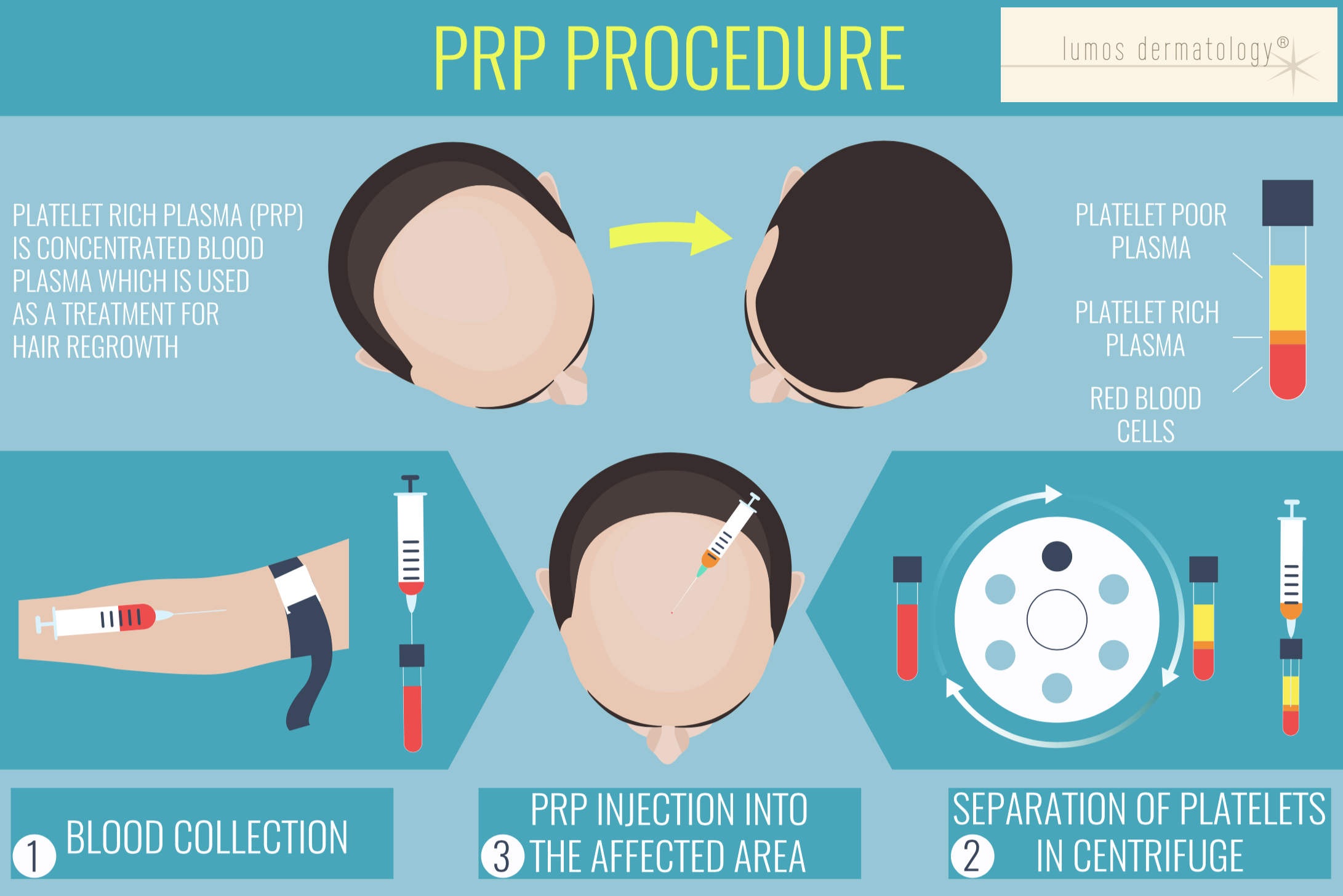 PRP procedure lumos dermatology.png