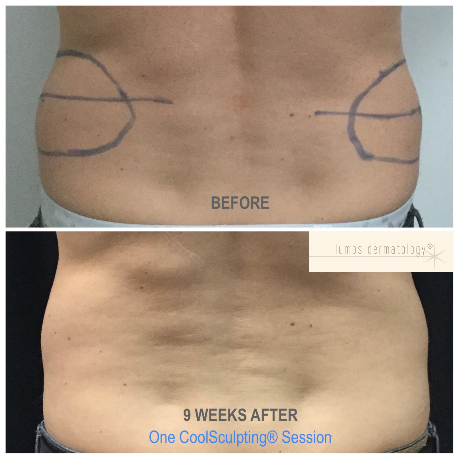 CoolSculpting flanks before and after 1 treatment.jpeg